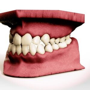 jaw my speech elevator and orofacial myology treatment